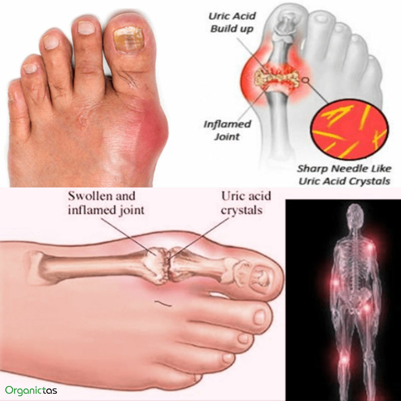 Gout Relief Herbal Tea in Gout, Arthritis, Rheumatism, Uric Acid, Joint Support
