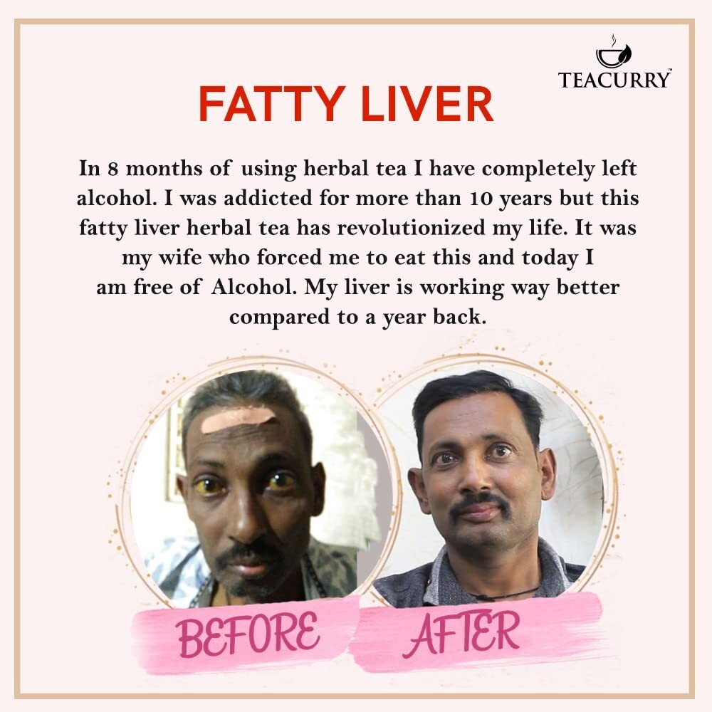TEACURRY Fatty Liver Tea (1 Month Pack, 30 Tea Bags) – Helps With Fatty Liver